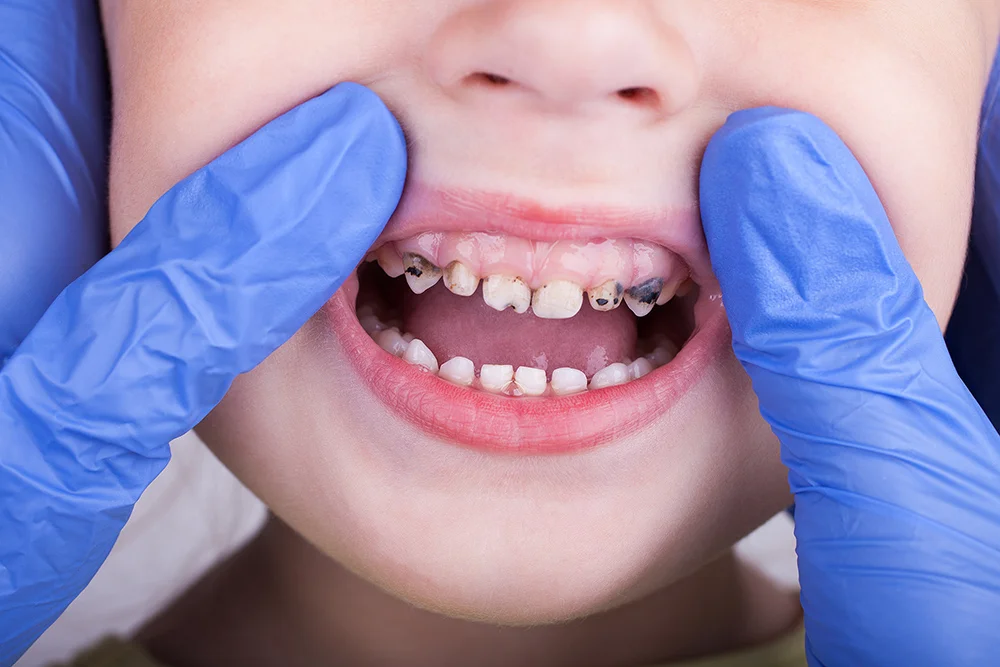 Bad Teeth Kids: Common Dental Problems in Children