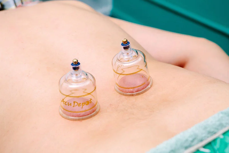 What is Cupping Therapy Used For and Does It Really Work?